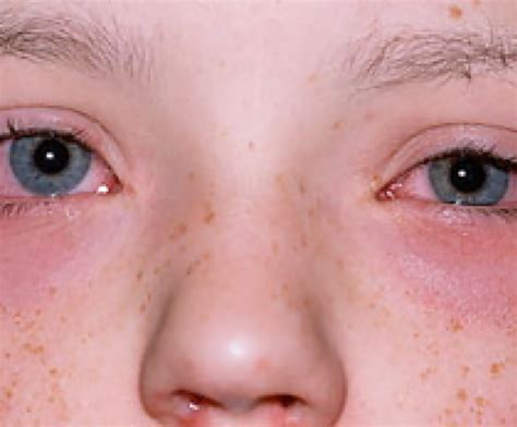 röda ögon vid pollenallergi